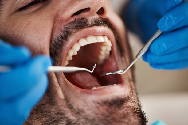 Best Emergency Root Canal Treatment in Drexel, OH